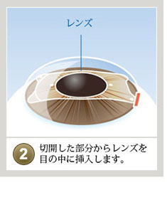 ICL眼科手術画像２
