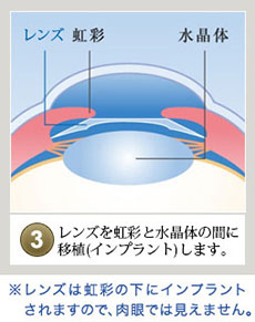 ICL眼科手術画像３